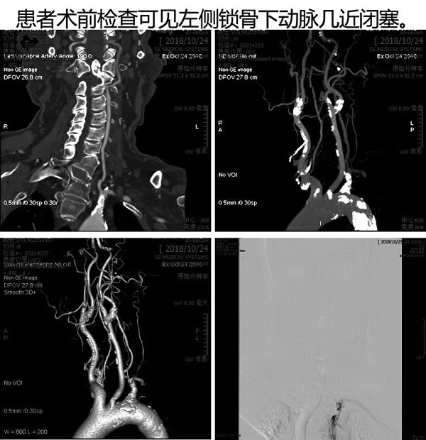 仁济首次应用3D影像融合技术实施左锁骨下动脉闭塞开通术