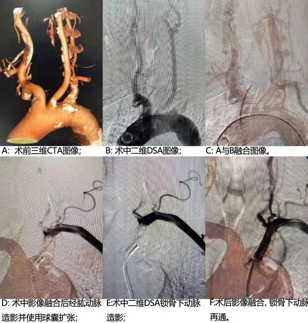 仁济首次应用3D影像融合技术实施左锁骨下动脉闭塞开通术