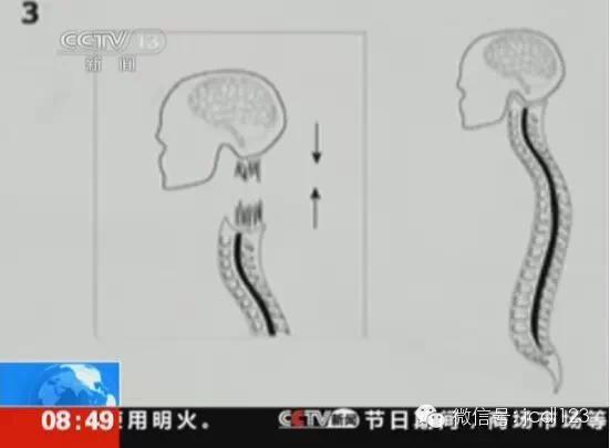 俄男子将接受世界首例头颅移植手术