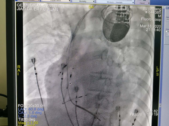 西安交大二附院心内科成功为一例严重心衰患者实施改良CRT