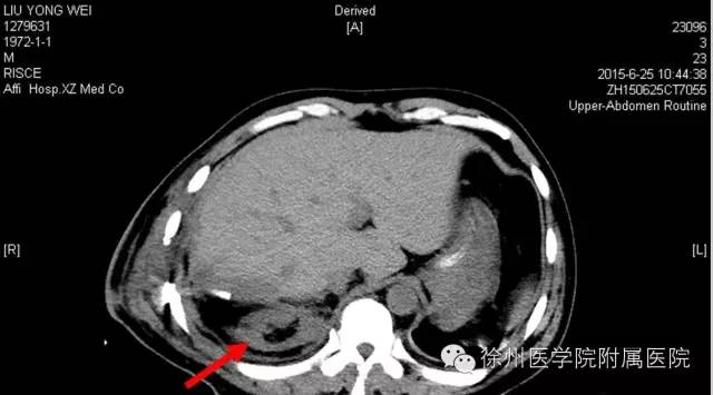 徐医附院回应男子术后右肾失踪：医院阅片发现萎缩的肾脏