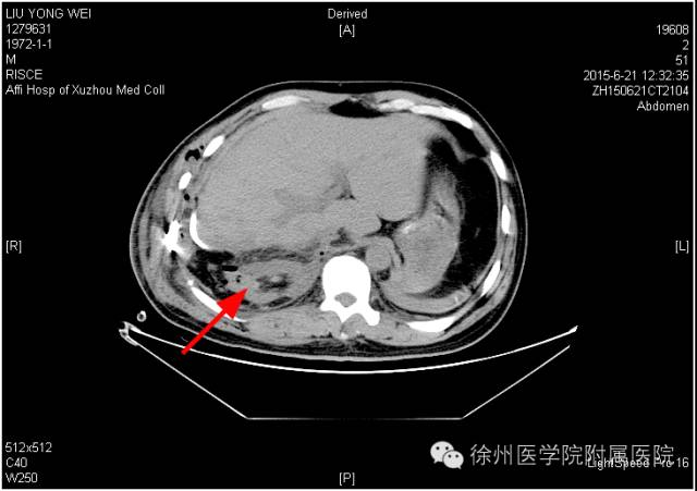 徐医附院回应男子术后右肾失踪：医院阅片发现萎缩的肾脏