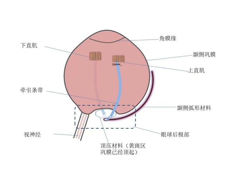 破解高度近视黄斑脱离难题！ 西安交大一附院眼科成功开展黄斑外加压术_fororder_微信图片_202208021506252