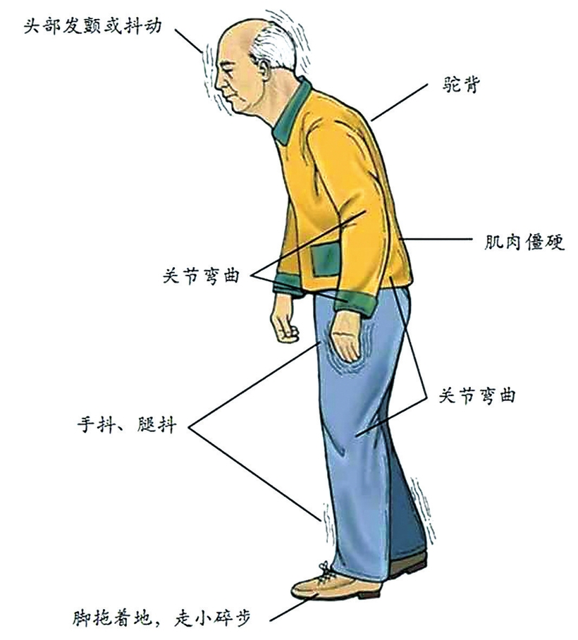 【健康医药（标题）】【关东黑土（长春）】【移动版（列表）】身体“抖僵慢” 警惕帕金森