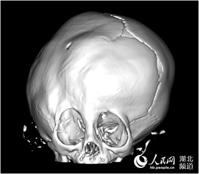 【滚动新闻】【美食健康】【荆州】【主页标题】男婴脑袋“跑偏” 专家借3D打印术再造颅骨【内容页标题】男婴脑袋一路“跑偏” 专家借3D打印术再造颅骨