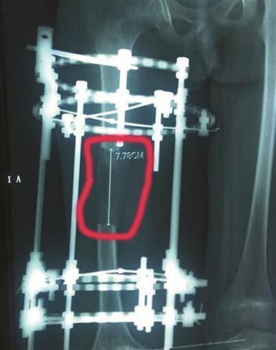 男孩右腿比左腿短近6厘米 经手术3个月恢复正常