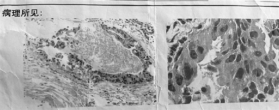 女子查出癌症复发放疗后被告知无癌 医院：过度诊断